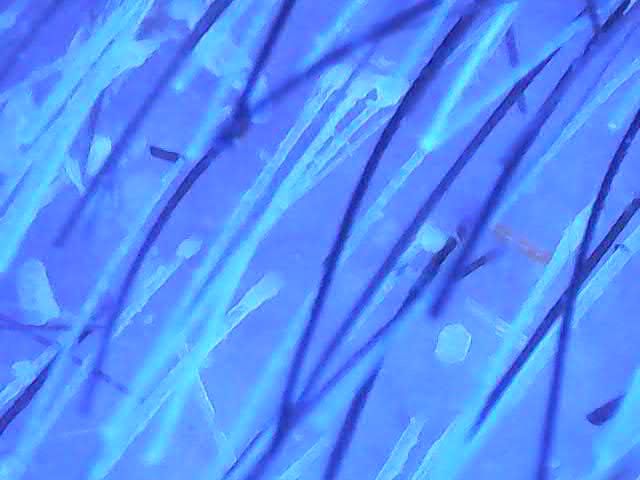 Dry Scalp Under Ultraviolet Light