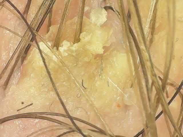 Dermatitis Under Normal Light